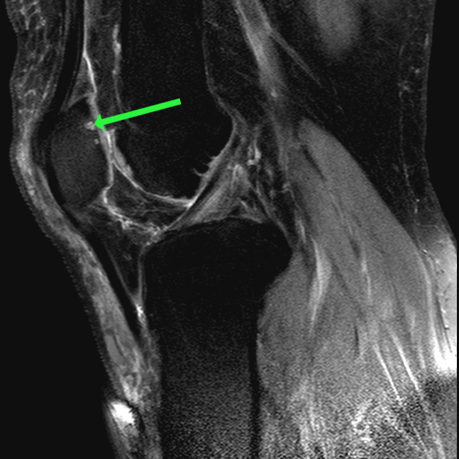 patellofemoral-chondromalacia-proscan-education